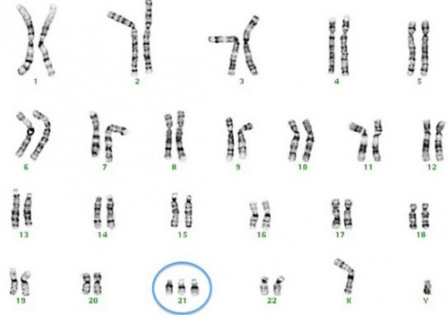 psicologiasdobrasil.com.br - A Síndrome de Down pode ter os dias contados