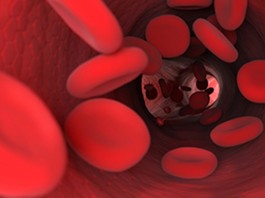 Tratamento precoce da depressão pode proteger o coração