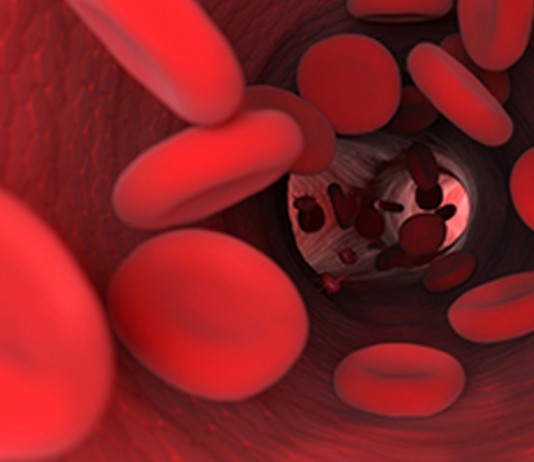 Tratamento precoce da depressão pode proteger o coração