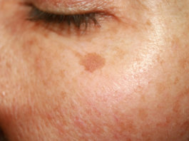 Habilidades Sociais: A pele e o estigma