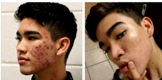 Risco de depressão é maior em quem sofre com acne