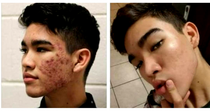 Risco de depressão é maior em quem sofre com acne