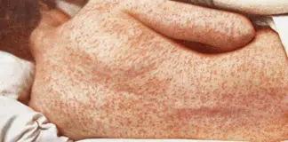 Movimento irresponsável antivacina está matando de sarampo pessoas na Europa Movimento irresponsável antivacina está matando de sarampo pessoas na Europa