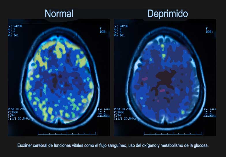 psicologiasdobrasil.com.br - Depressão faz o cérebro envelhecer mais rápido