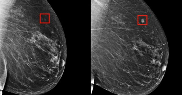Com inteligência artificial, câncer de mama pode ser previsto cinco anos antes