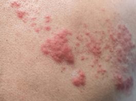 Depois dos 50, é preciso tomar a vacina contra o herpes-zóster