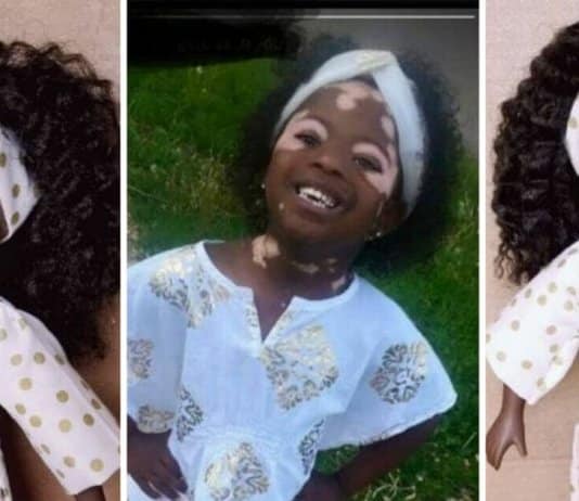 Bonecas com vitiligo ajudam crianças com mesma condição a gostarem de si mesmas