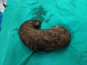 psicologiasdobrasil.com.br - Conheça a tricofagia, distúrbio que fez uma adolescente engolir 1,3 kg de cabelo