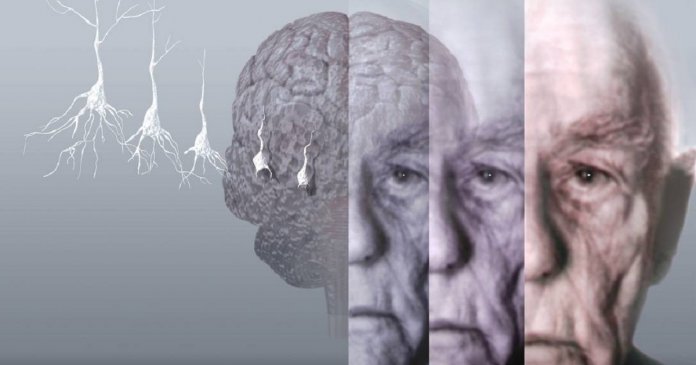 Depressão pode afetar o cérebro tanto quanto o Alzheimer