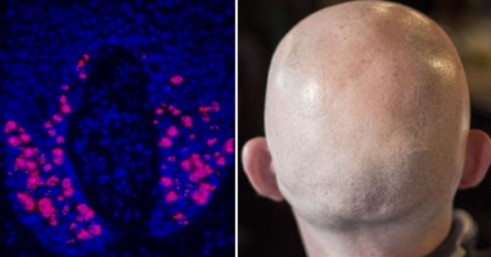 Cientistas descobrem tratamento que evita perda de cabelo durante quimioterapia
