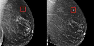 Inteligência artificial jé é capaz de prever câncer de mama cinco anos antes de apresentar sintomas