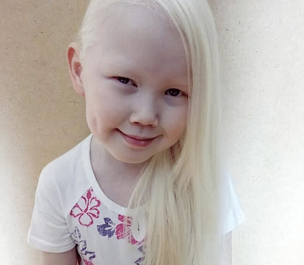 psicologiasdobrasil.com.br - Menina albina de 8 anos choca o mundo com sua beleza &uacute;nica