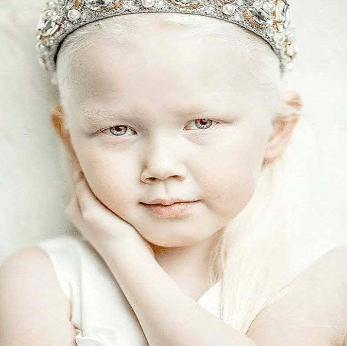 psicologiasdobrasil.com.br - Menina albina de 8 anos choca o mundo com sua beleza &uacute;nica