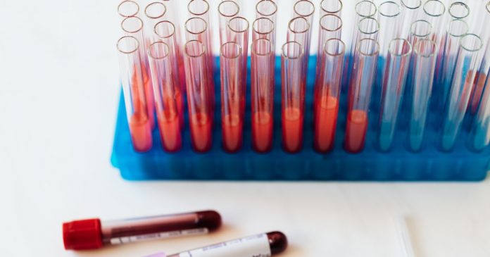 Novo exame de sangue permite diagnóstico de bipolaridade e esquizofrenia