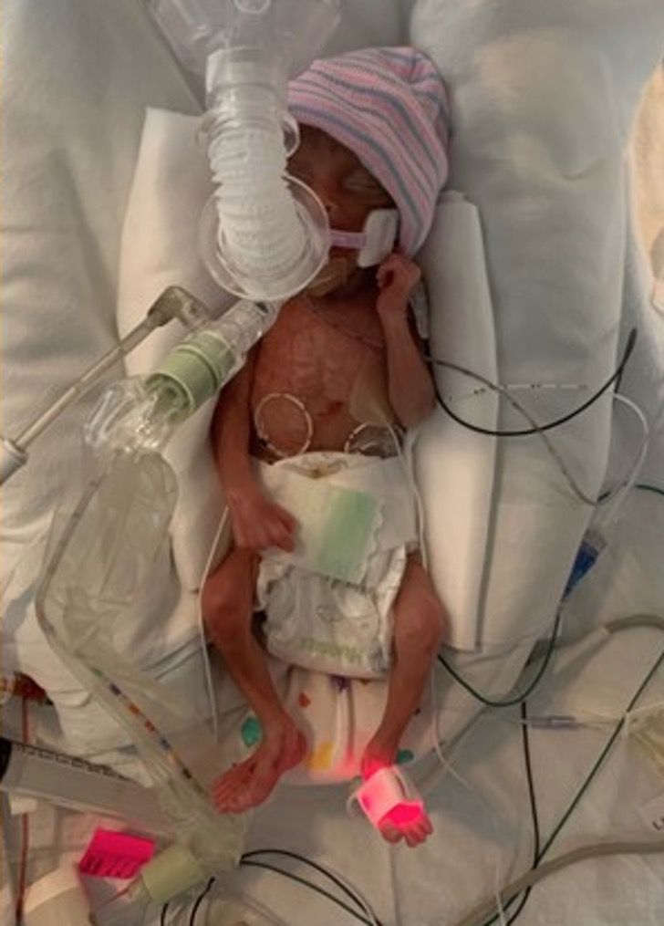 psicologiasdobrasil.com.br - Valente bebê prematuro nascido com 22 semanas conseguiu sobreviver. Deixou o hospital como um rei