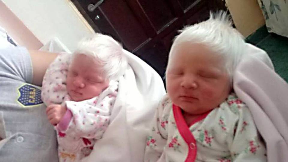 psicologiasdobrasil.com.br - Essas gêmeas nasceram com lindos cabelos brancos