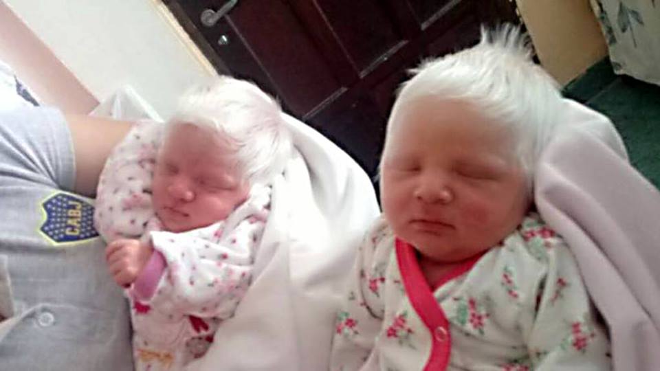 psicologiasdobrasil.com.br - Essas gêmeas nasceram com lindos cabelos brancos