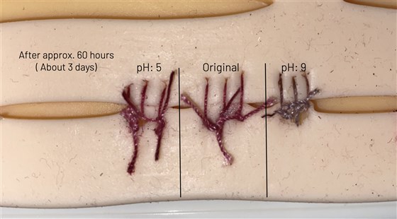 psicologiasdobrasil.com.br - Estudante de 17 anos cria suturas que mudam de cor ao detectar uma infecção