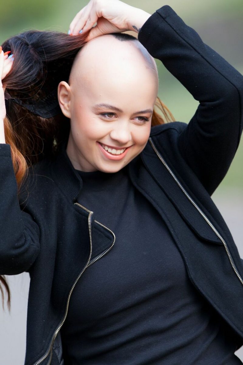 psicologiasdobrasil.com.br - Jornalista desiste de perucas, aceita sua alopecia e convida as pessoas a se amarem como são