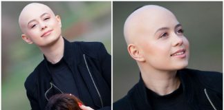 Jornalista desiste de perucas, aceita sua alopecia e convida as pessoas a se amarem como são