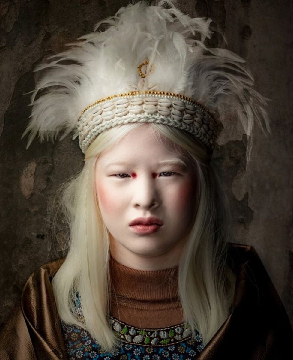psicologiasdobrasil.com.br - Chinesa albina que foi abandonada quando bebê se torna modelo da Vogue