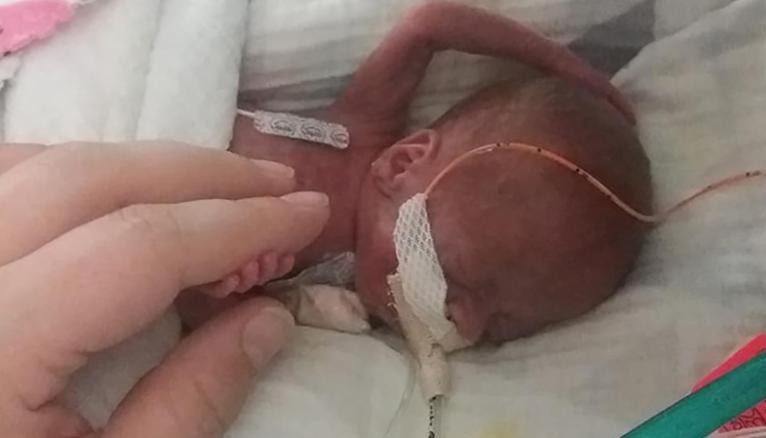 psicologiasdobrasil.com.br - Ele venceu: Bebê que nasceu prematuro com 340 g e 12 cm comemora primeiro aniversário