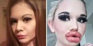 Mulher quer os maiores lábios do mundo e já fez preenchimento labial 21 vezes Mulher quer os maiores lábios do mundo e já fez preenchimento labial 21 vezes