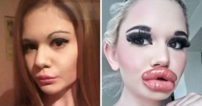 Mulher quer os maiores lábios do mundo e já fez preenchimento labial 21 vezes