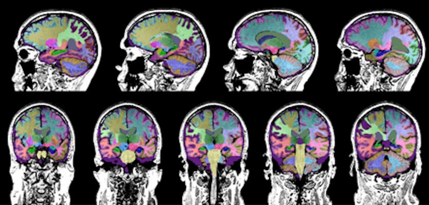 psicologiasdobrasil.com.br - Novo algoritmo pode identificar alterações cerebrais pré-Alzheimer com 99% de precisão