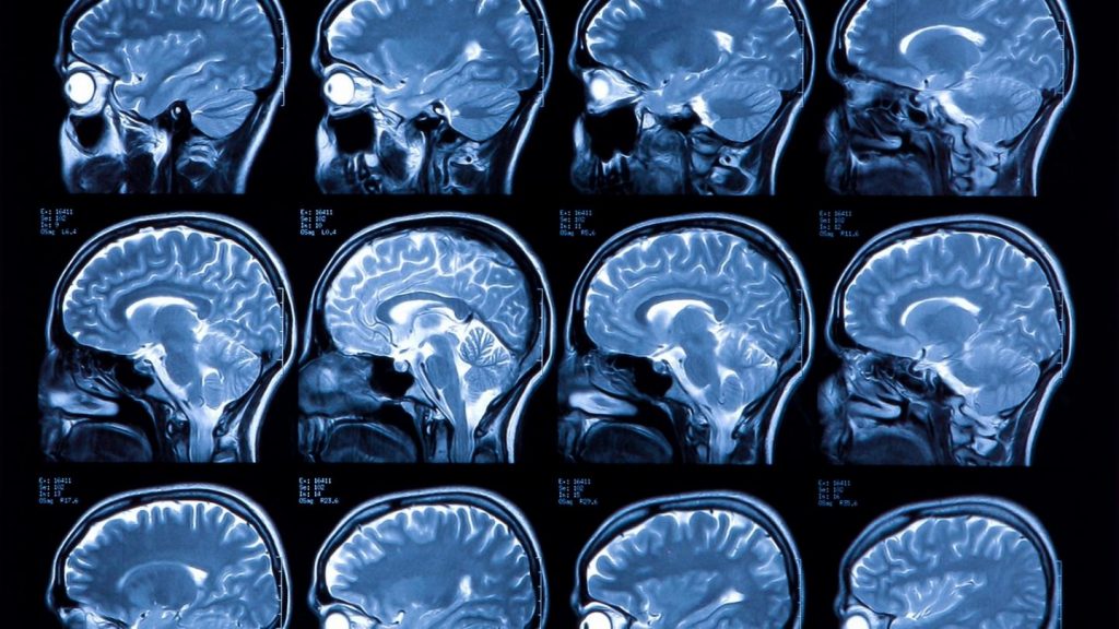 psicologiasdobrasil.com.br - Novo algoritmo pode identificar alterações cerebrais pré-Alzheimer com 99% de precisão