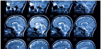 Novo algoritmo pode identificar alterações cerebrais pré-Alzheimer com 99% de precisão
