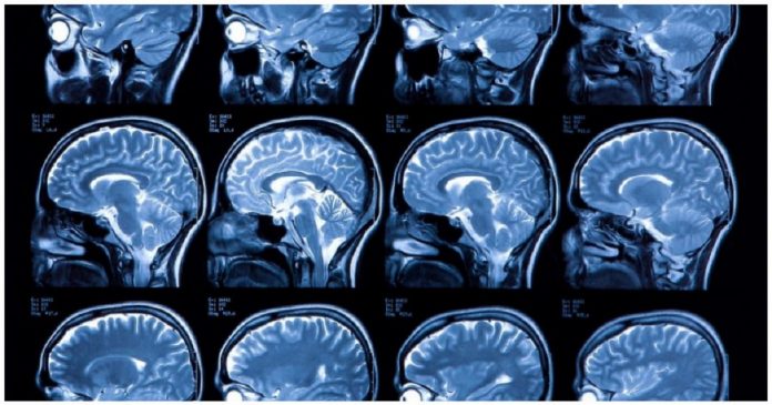 Novo algoritmo pode identificar alterações cerebrais pré-Alzheimer com 99% de precisão