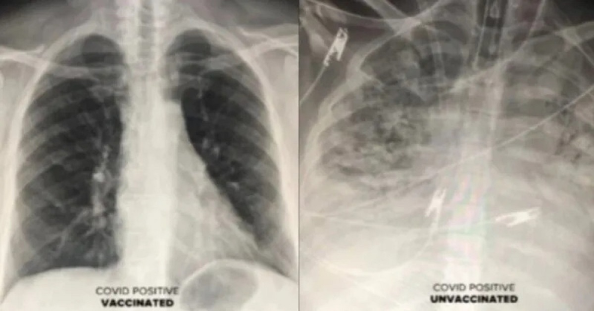 psicologiasdobrasil.com.br - Médico exibe raio-x do efeito da covid no pulmão de pessoas vacinadas