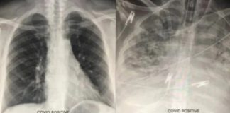 Médico exibe raio-x do efeito da covid no pulmão de pessoas vacinadas
