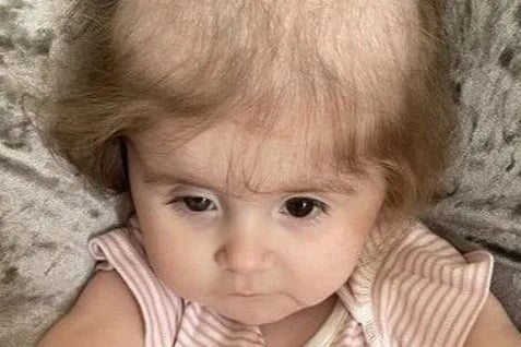 psicologiasdobrasil.com.br - Doença rara faz menina de 2 anos arrancar o próprio cabelo para comer
