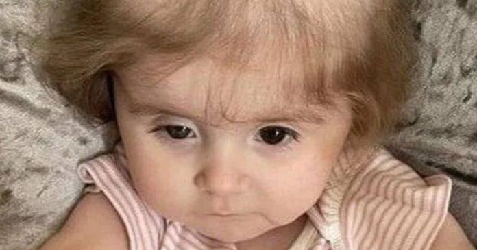 Doença rara faz menina de 2 anos arrancar o próprio cabelo para comer