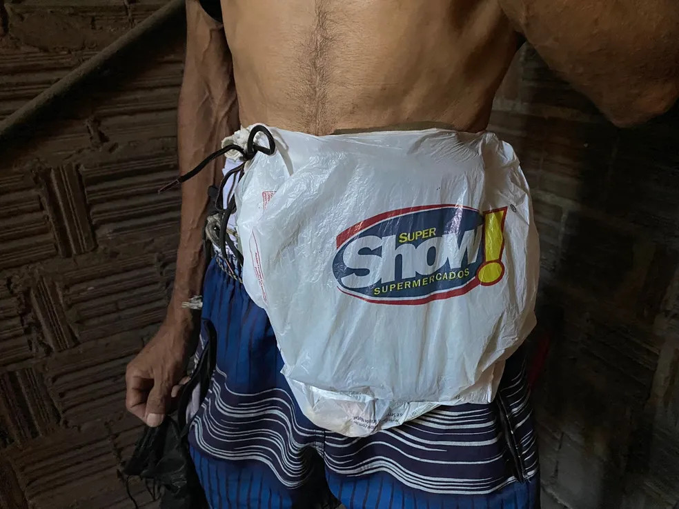 psicologiasdobrasil.com.br - Por falta de bolsa de colostomia, paciente improvisa com sacola de supermercado: 'Não aguento mais tanto sofrimento'