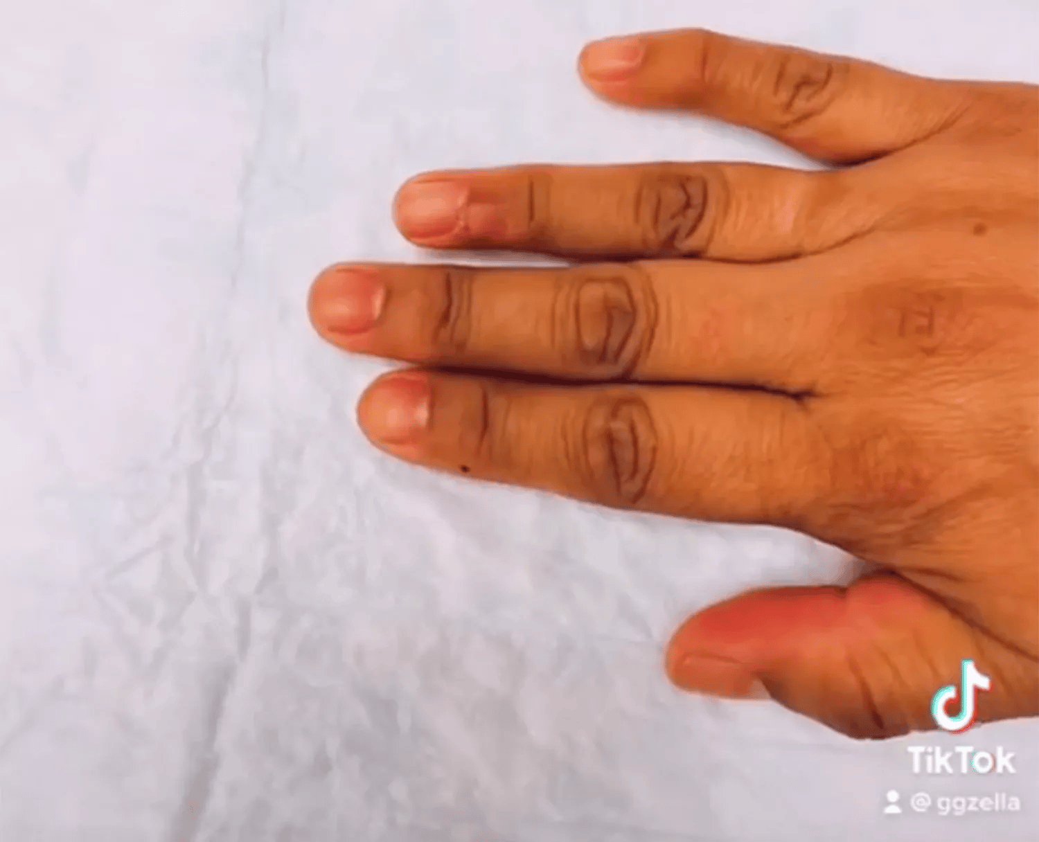 psicologiasdobrasil.com.br - Mulher descobre câncer após lesão ao fazer as unhas no salão
