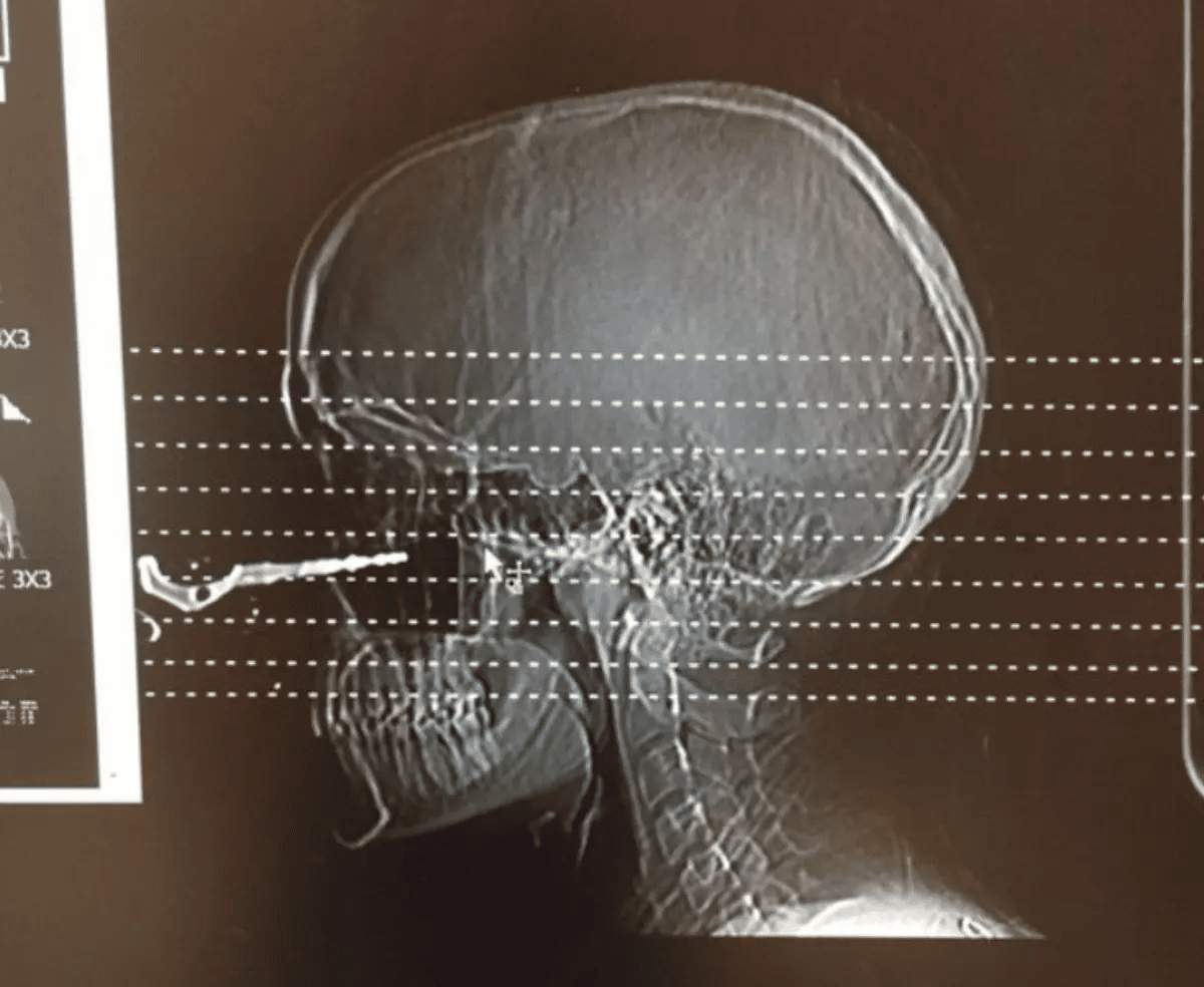 psicologiasdobrasil.com.br - Jovem tem chave fincada no rosto depois de amiga arremessar objeto pela janela