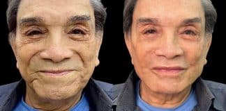 Dedé Santana faz harmonização facial aos 86 anos