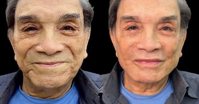 Dedé Santana faz harmonização facial aos 86 anos