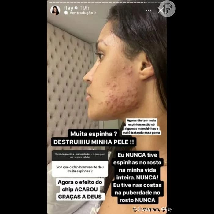 psicologiasdobrasil.com.br - Ex-BBB Flay denuncia danos causados por chip da beleza: 'Tristeza'