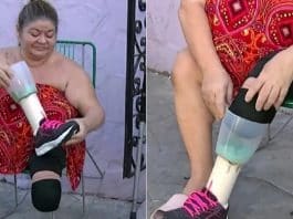 Mulher com a perna amputada faz prótese improvisada com liquidificador