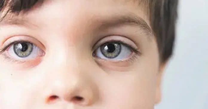 IA identifica autismo através da retina com 100% de precisão
