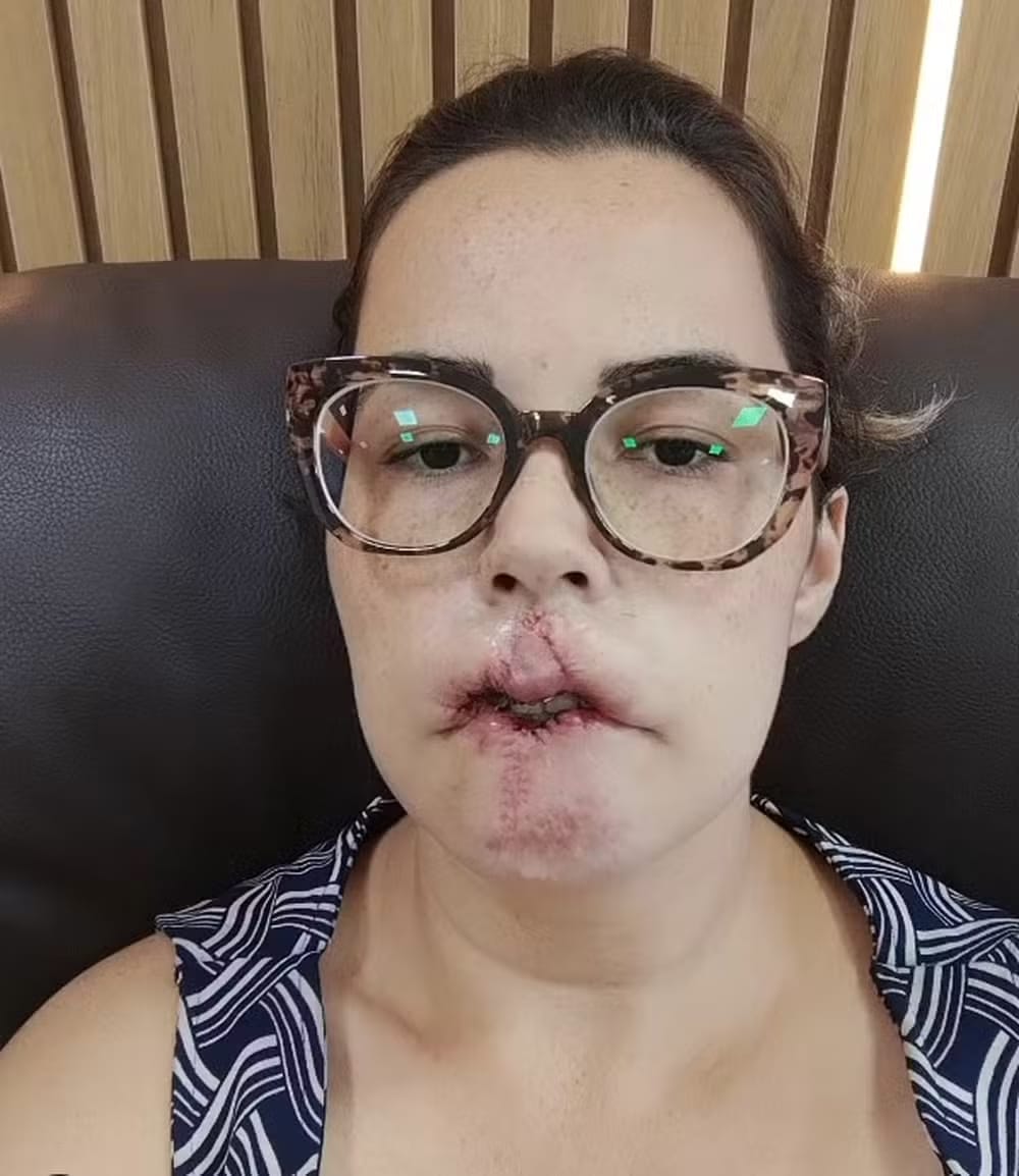 psicologiasdobrasil.com.br - Mulher perde o lábio superior após se submeter a harmonização facial com PMMA