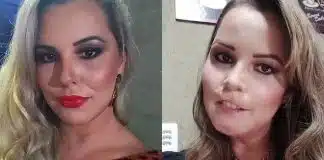 Mulher perde o lábio superior após se submeter a harmonização facial com PMMA