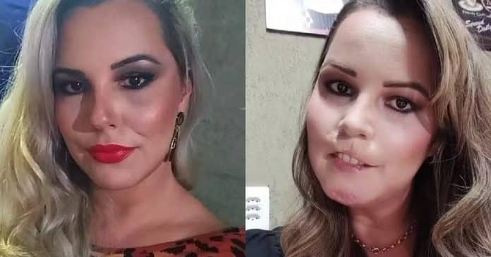 Mulher perde o lábio superior após se submeter a harmonização facial com PMMA