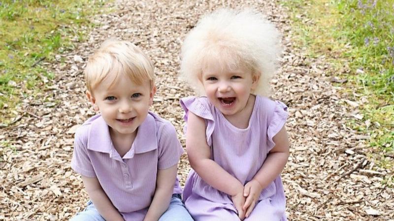 psicologiasdobrasil.com.br - 'O cabelo da minha filha é lindo', diz mãe de menina com a síndrome do cabelo impenteável