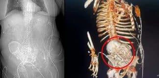 Idosa descobre feto calcificado que carregou por mais de 50 anos e falece após cirurgia de retirada