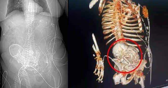Idosa descobre feto calcificado que carregou por mais de 50 anos e falece após cirurgia de retirada